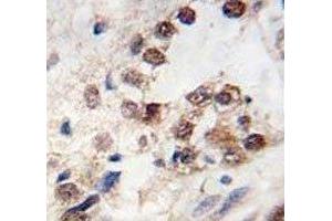 IHC testing of KLF4 antibody and FFPE human prostate carcinoma