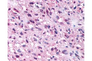 Anti-NPSR1 / NPSR / GPR154 antibody IHC of human Brain, Glioblastoma. (NPSR1 anticorps  (Extracellular Domain))