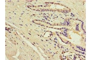 Immunohistochemistry of paraffin-embedded human prostate cancer using ABIN7143204 at dilution of 1:100 (ACSF3 anticorps  (AA 365-484))