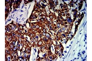 Immunohistochemical analysis of paraffin-embedded esophageal cancer tissues using KRT13 mouse mAb with DAB staining. (Cytokeratin 13 anticorps  (AA 104-458))