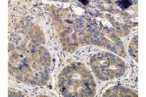 SLC5A1 Mouse Monoclonal Antibody at 1/100 staining human lung cancer and adjacent non-tumor tissue by IHC-P.