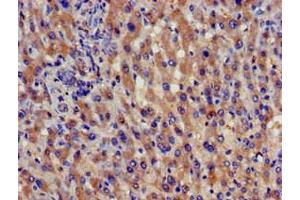 Immunohistochemistry of paraffin-embedded human liver cancer using ABIN7159025 at dilution of 1:100 (SPG21 anticorps  (AA 1-308))
