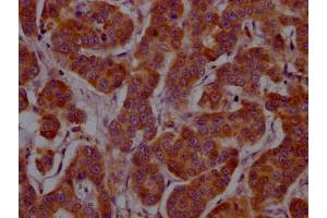 IHC image of ABIN7127570 diluted at 1:100 and staining in paraffin-embedded human breast cancer performed on a Leica BondTM system. (Recombinant IL-4 anticorps)