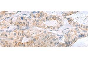Immunohistochemistry of paraffin-embedded Human thyroid cancer tissue using PHLDA3 Polyclonal Antibody at dilution of 1:110(x200) (PHLDA3 anticorps)