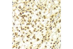 Immunohistochemistry of paraffin-embedded Human kidney cancer using Lamin A/C antibody (ABIN5970079) at dilution of 1/100 (40x lens). (Lamin A/C anticorps)
