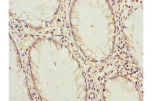 Immunohistochemistry of paraffin-embedded human colon cancer using ABIN7145189 at dilution of 1:100 (B9D2 anticorps  (AA 1-175))