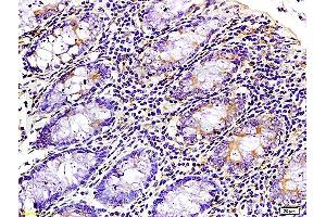 Formalin-fixed and paraffin-embedded : human colon carcinoma labeled with Rabbit Anti-WNK3 protein Polyclonal Antibody , Unconjugated 1:200 followed by conjugation to the secondary antibody