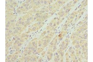 Immunohistochemistry of paraffin-embedded human liver cancer using ABIN7159907 at dilution of 1:100 (TIMM8A/DDP anticorps  (AA 1-97))