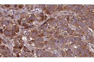 ABIN6273841 at 1/100 staining Human liver cancer tissue by IHC-P. (CCR2 anticorps  (Internal Region))