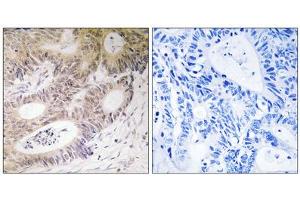 Immunohistochemistry analysis of paraffin-embedded human colon carcinoma tissue, using MSK1 (epitope around residue 212) antibody.
