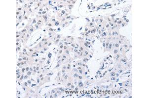 Immunohistochemistry of Human lung cancer using POMC Polyclonal Antibody at dilution of 1:30 (POMC anticorps)