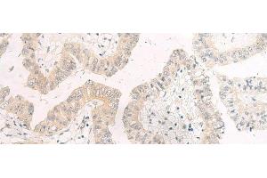 Immunohistochemistry of paraffin-embedded Human liver cancer tissue using HASPIN Polyclonal Antibody at dilution of 1:45(x200) (GSG2 anticorps)