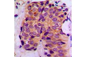 Immunohistochemical analysis of MAGEA1 staining in human breast cancer formalin fixed paraffin embedded tissue section.