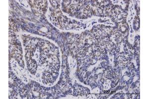Immunoperoxidase of monoclonal antibody to UBE2D1 on formalin-fixed paraffin-embedded human cervix cancer.