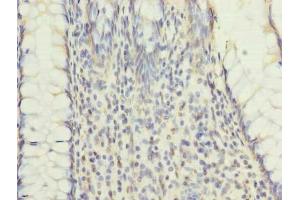 Immunohistochemistry of paraffin-embedded human colon cancer using ABIN7151184 at dilution of 1:100 (RNF26 anticorps  (AA 246-433))