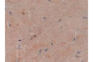 Detection of COL6a3 in Human Lung cancer Tissue using Polyclonal Antibody to Collagen Type VI Alpha 3 (COL6a3)