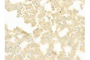 ABIN6259921 and ABIN6277899 at 1/100 staining human melanoma by IHC-P. (Amylin/DAP anticorps  (Internal Region))
