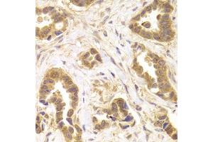 Immunohistochemistry of paraffin-embedded human mammary cancer using ROCK2 antibody.