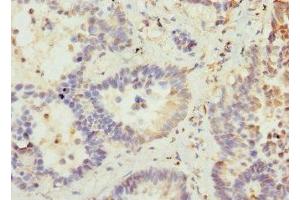 Immunohistochemistry of paraffin-embedded human lung cancer using ABIN7175358 at dilution of 1:100