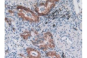 Detection of MSTN in Human Lung cancer Tissue using Polyclonal Antibody to Myostatin (MSTN)