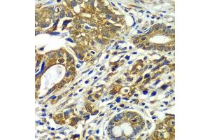 Immunohistochemistry of paraffin-embedded human gastric cancer using CDC16 antibody  at dilution of 1:100 (40x lens). (CDC16 anticorps  (AA 371-620))