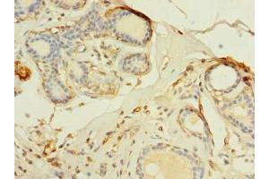 Immunohistochemistry of paraffin-embedded human breast cancer using ABIN7173099 at dilution of 1:100