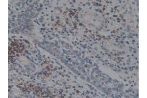 IHC-P analysis of Human Skin Cancer Tissue, with DAB staining. (Angiotensin I Converting Enzyme 1 anticorps  (AA 1160-1306))