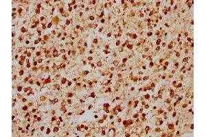 IHC image of ABIN7153409 diluted at 1:200 and staining in paraffin-embedded human glioma performed on a Leica BondTM system. (GABPA anticorps  (AA 268-372))