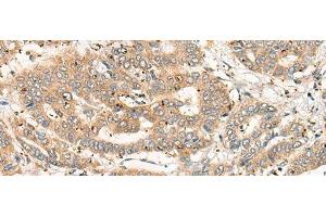 Immunohistochemistry of paraffin-embedded Human liver cancer tissue using CPNE4 Polyclonal Antibody at dilution of 1:40(x200) (Copine IV anticorps)