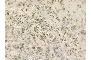 ABIN6258406 and ABIN6275684 at 1/100 staining human melanoma by IHC-P. (ZBTB40 anticorps  (Internal Region))