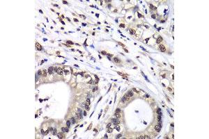 Immunohistochemistry of paraffin-embedded human liver cancer using HNRNPM antibody at dilution of 1:100 (x40 lens). (HNRNPM anticorps)