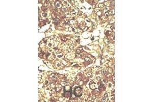 Formalin-fixed and paraffin-embedded human cancer tissue reacted with the primary antibody, which was peroxidase-conjugated to the secondary antibody, followed by AEC staining.