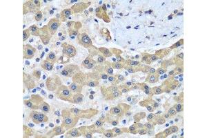 Immunohistochemistry of paraffin-embedded Human liver cancer using GFM1 Polyclonal Antibody at dilution of 1:100 (40x lens). (GFM1 anticorps)