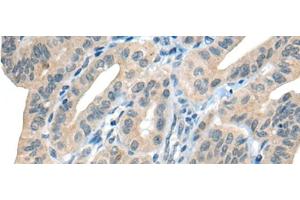 Immunohistochemistry of paraffin-embedded Human thyroid cancer tissue using CHAT Polyclonal Antibody at dilution of 1:30(x200) (Choline Acetyltransferase anticorps)
