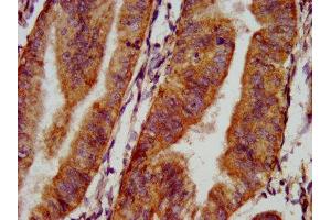 IHC image of ABIN7161158 diluted at 1:500 and staining in paraffin-embedded human endometrial cancer performed on a Leica BondTM system.