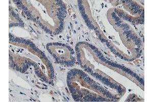 Immunohistochemical staining of paraffin-embedded Adenocarcinoma of Human colon tissue using anti-ATG3 mouse monoclonal antibody. (ATG3 anticorps)