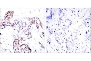 Immunohistochemistry analysis of paraffin-embedded human breast carcinoma, using Elk1 (Phospho-Ser389) Antibody. (ELK1 anticorps  (pSer389))