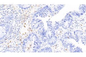 Detection of CALPRO in Human Colorectal cancer Tissue using Polyclonal Antibody to Calprotectin (CALPRO) (S100A8/A9 Complex (Calprotectin) anticorps  (AA 1-114))