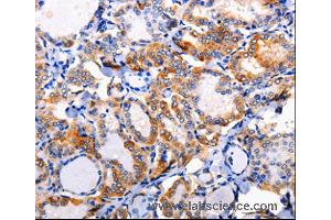 Immunohistochemistry of Human liver cancer using AP1B1 Polyclonal Antibody at dilution of 1:100