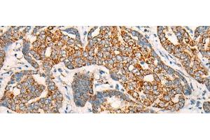 Immunohistochemistry of paraffin-embedded Human liver cancer tissue using CCT8L2 Polyclonal Antibody at dilution of 1:45(x200) (CCT8L2 anticorps)