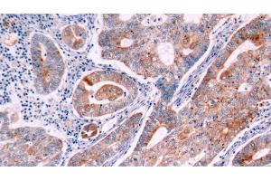 Detection of Bcl2 in Human Endometrial cancer Tissue using Polyclonal Antibody to B-Cell Leukemia/Lymphoma 2 (Bcl2)