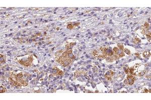 ABIN6272590 at 1/100 staining Human liver cancer tissue by IHC-P. (IL31RA anticorps  (Internal Region))