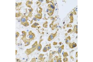 Immunohistochemistry of paraffin-embedded human liver cancer using BTD antibody (ABIN6127510, ABIN6137680, ABIN6137682 and ABIN6221882) at dilution of 1:100 (40x lens).