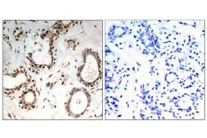 Immunohistochemical analysis of paraffin-embedded human breast carcinoma tissue, using HSF1 (Ab-307) antibody (E021206). (HSF1 anticorps)