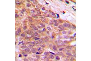Immunohistochemical analysis of CABLES1 staining in human breast cancer formalin fixed paraffin embedded tissue section.