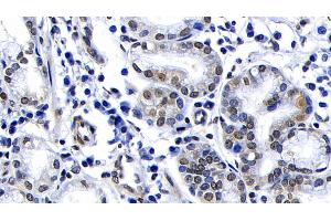 Detection of ATM in Human Stomach cancer Tissue using Polyclonal Antibody to Ataxia Telangiectasia Mutated (ATM)