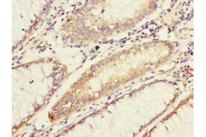 Immunohistochemistry of paraffin-embedded human colon cancer using ABIN7143328 at dilution of 1:100 (ADCY4 anticorps  (AA 808-1077))