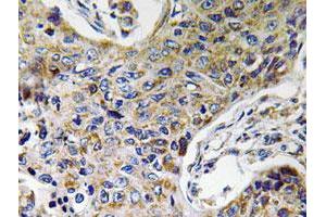 Immunohistochemical analysis of paraffin-embedded human lung cancer tissue using ATP5J2 polyclonal antibody . (ATP5J2 anticorps)