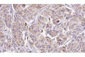 ABIN6277257 at 1/100 staining Human Melanoma tissue by IHC-P. (IL-8 anticorps  (Internal Region))