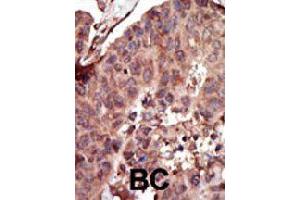 Formalin-fixed and paraffin-embedded human cancer tissue reacted with PKLR polyclonal antibody  , which was peroxidase-conjugated to the secondary antibody, followed by AEC staining . (PKLR anticorps  (C-Term))